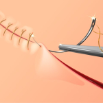 Правильный уход за швами после пластической операции