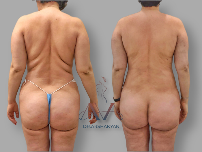 Пациентка доктора Вардана Аршакяна до и после липосакции Body Tite