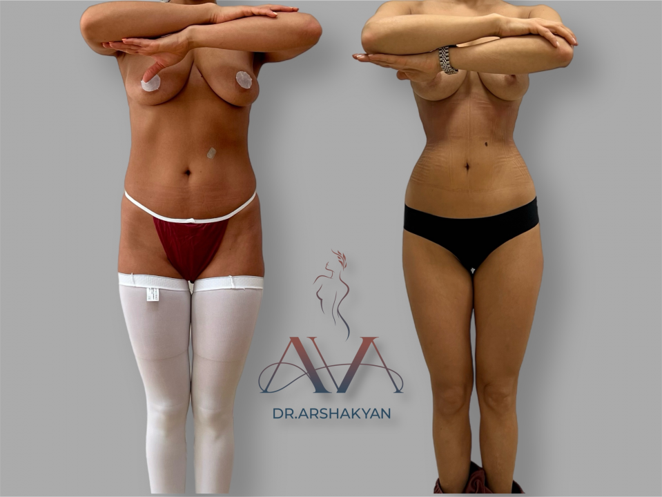 Пациентка доктора Вардана Аршакяна до и после операции по формированию узкой талии