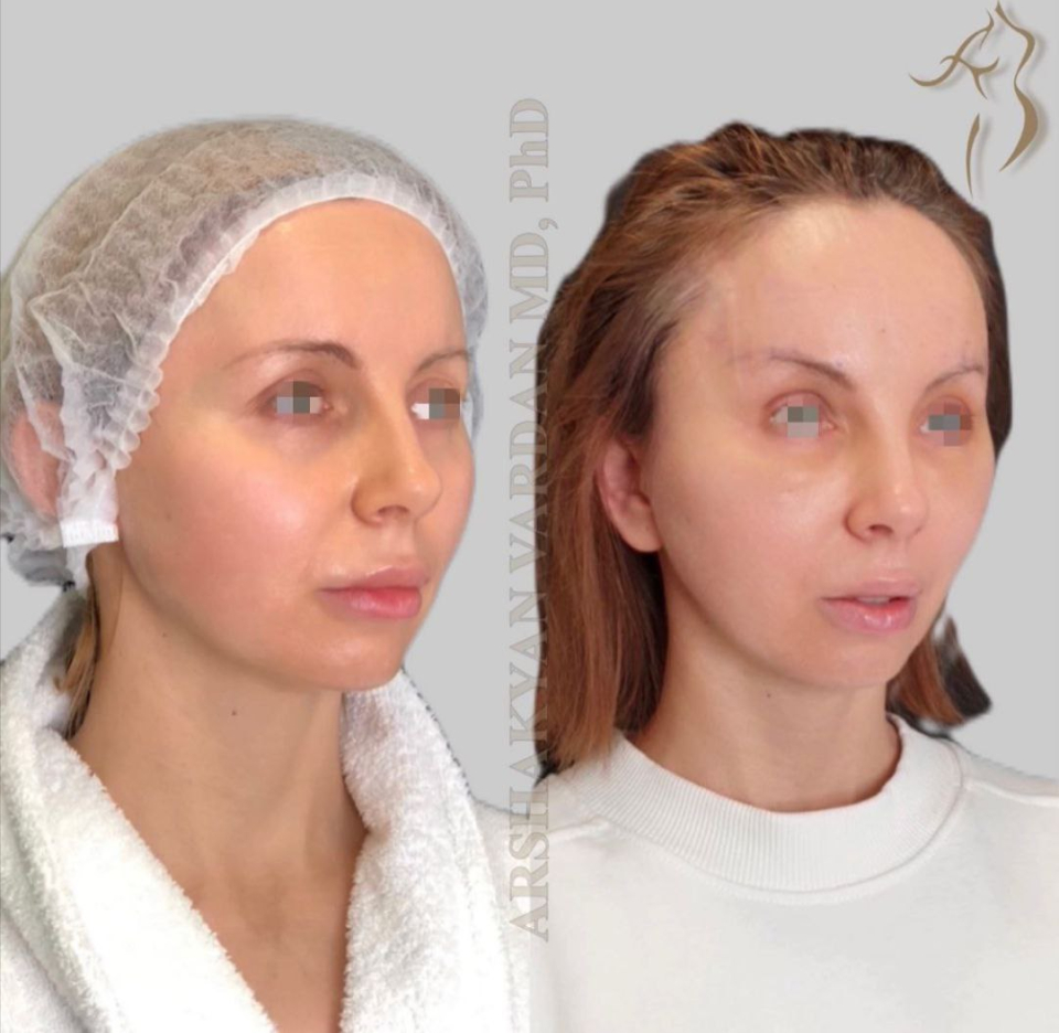 Пациентка доктора Вардана Аршакяна до и после эндоскопического лифтинга лба
