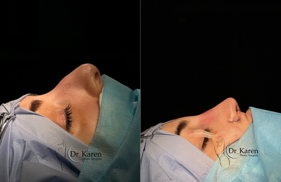 Пациентка доктора Пайтяна. Ринопластика результат до/после