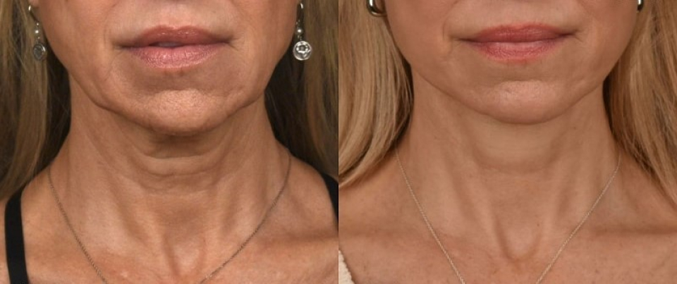 Фото до и после операции по подтяжке шеи.