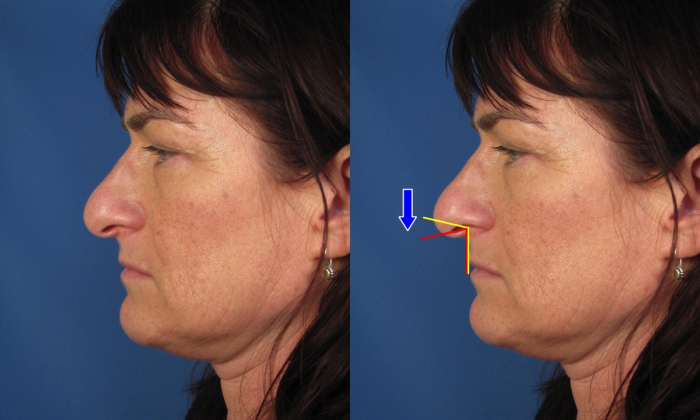 Пластика кончика носа