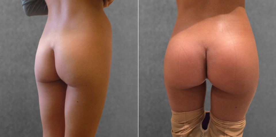 Пациентка доктора Дмитрия Крысина до и после глютеопластики