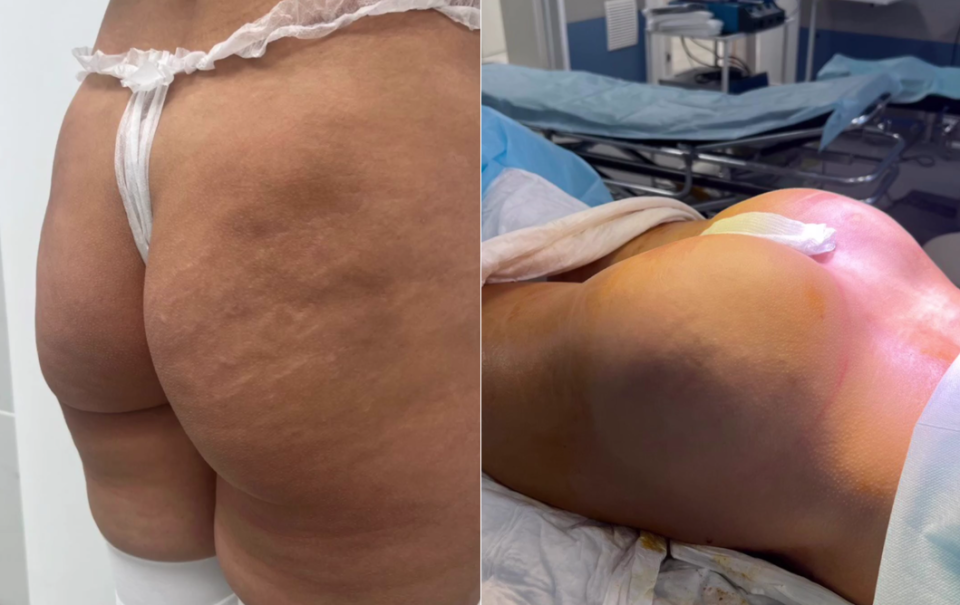 Пациентка доктора Дмитрия Крысина до и сразу после глютеопластики