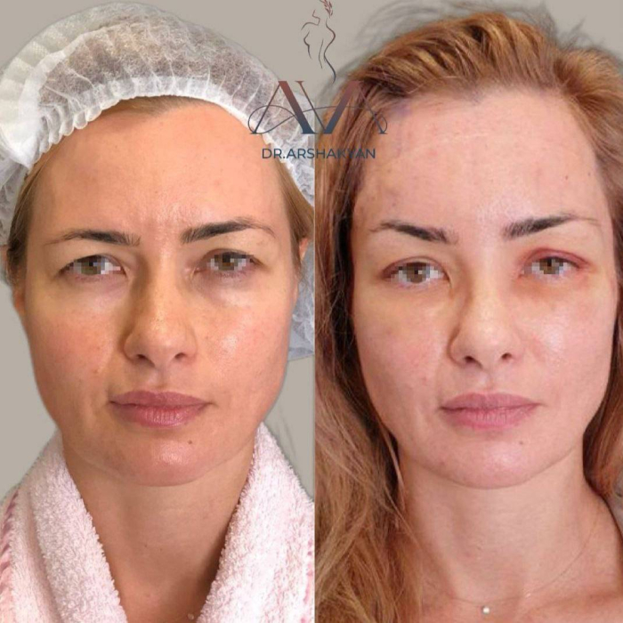 Пациентка доктора Вардана Аршакяна до и после эндоскопического лифтинга лба