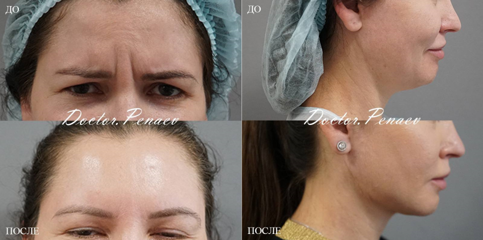 Пациентка доктора Пенаева до и после омолаживающей операции Мультитехнологичный лифтинг лица