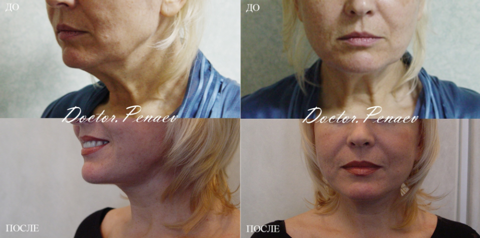 Пациентка доктора Пенаева до и после омолаживающей операции