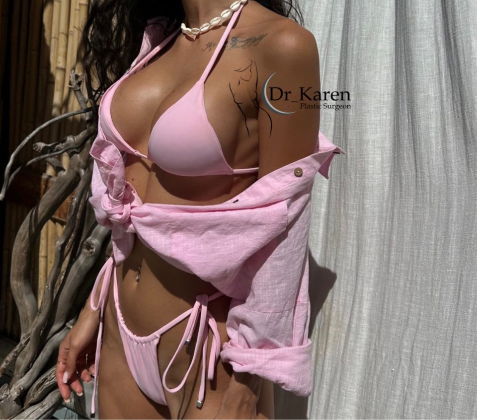 Пациентка доктора Карена Пайтяна после увеличения груди