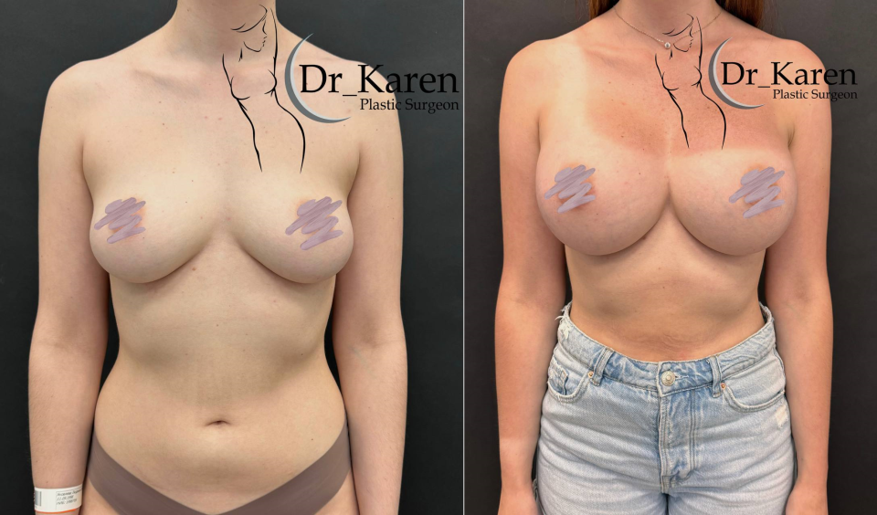 Пациентка доктора Карена Пайтяна до и после увеличения груди