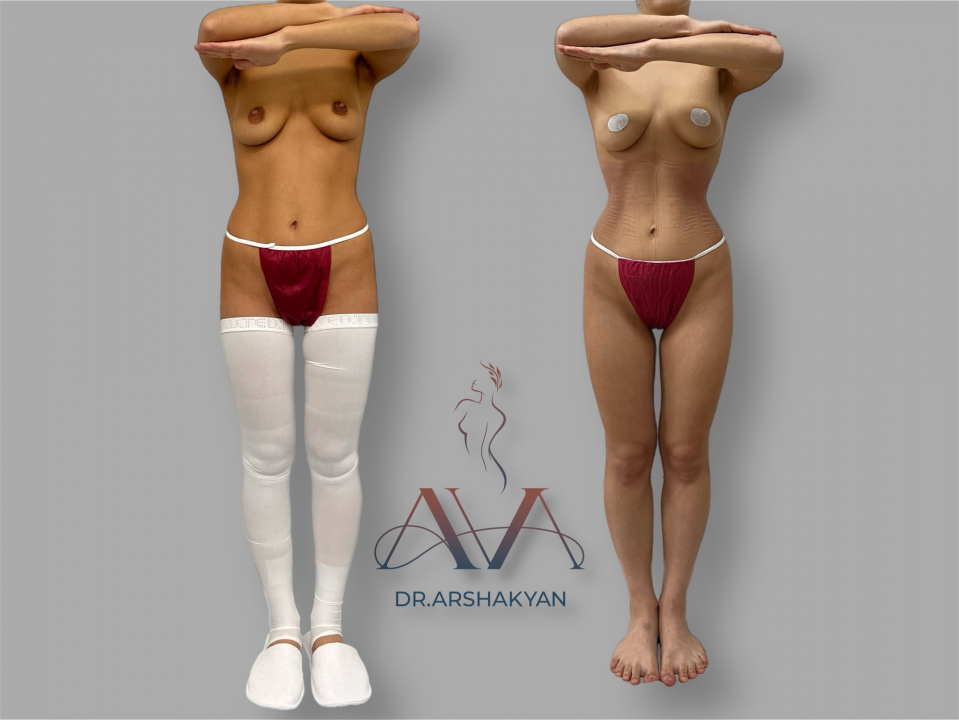 Пациентка хирурга Вардана Аршакяна до и после операции по формированию узкой талии без удаления ребер