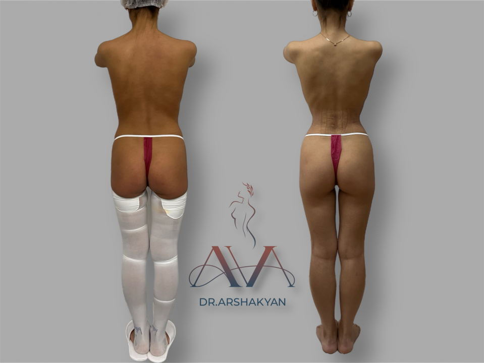 Пациентка хирурга Вардана Аршакяна до и после операции по формированию узкой талии