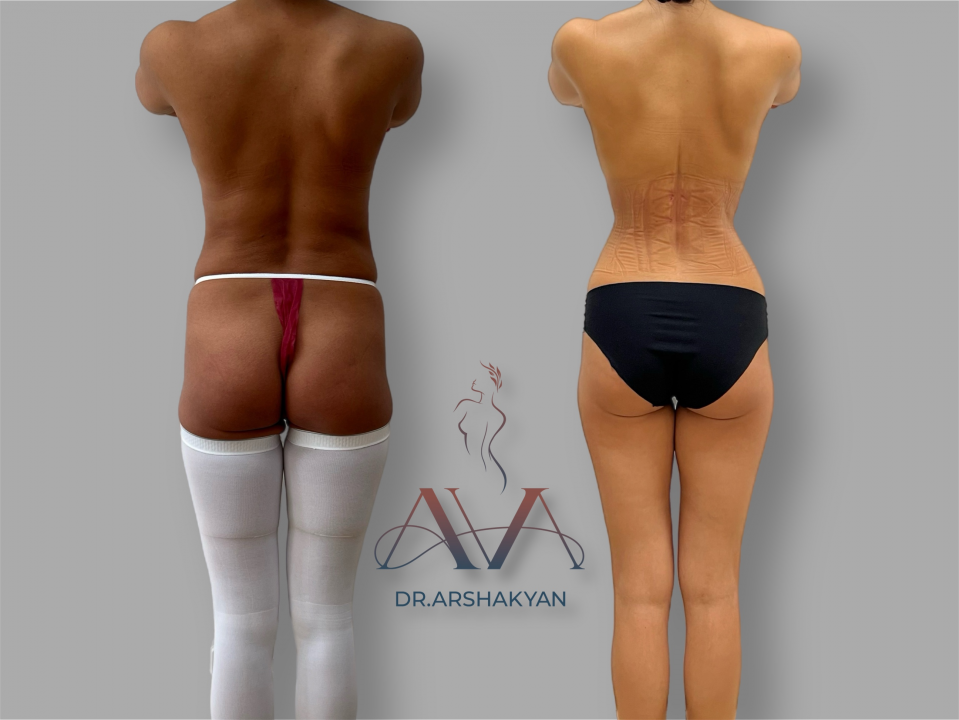Пациентка доктора Аршакяна до и после операции по формированию узкой талии без удаления ребер