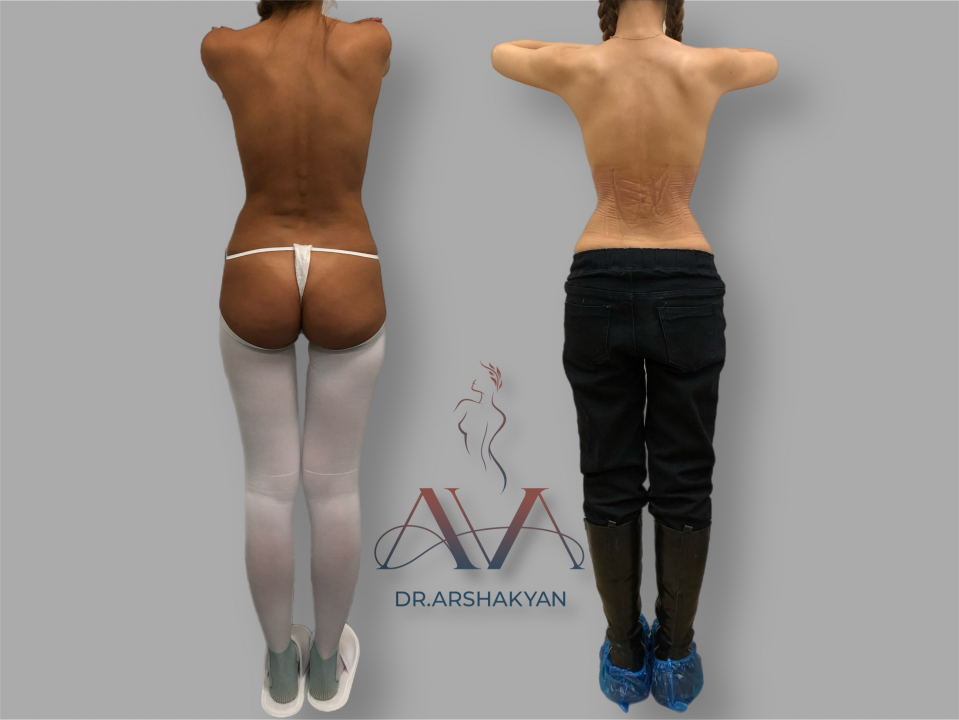 Пациентка хирурга Вардана Аршакяна до и после операции по созданию узкой талии