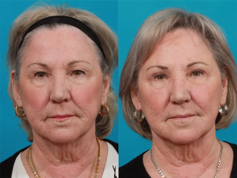 Пациентка пластического хирурга Гукаса Миракяна. Фото до и после операции по блефаропластике