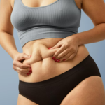  4 медицинских преимущества абдоминопластики