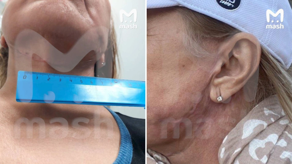 Мать Виктории Бони столкнулась с осложнениями после подтяжки лица