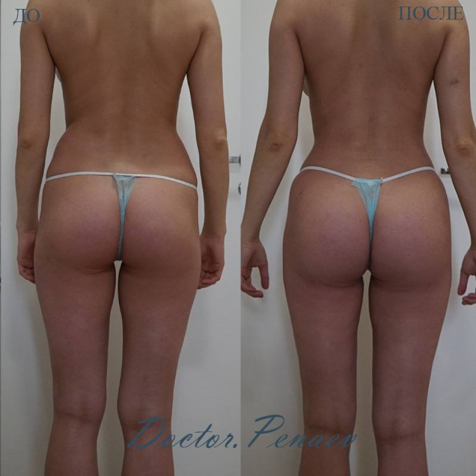 Пациентка  доктора Пенаева А.А. До и после липосакции и липотрансфера ягодиц