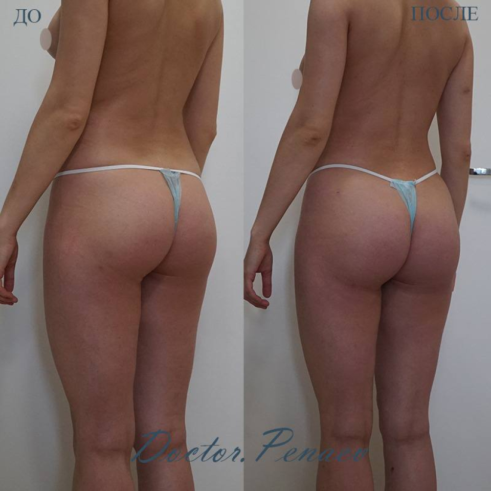 Пациентка  доктора Пенаева до и после липосакции и липотрансфера ягодиц