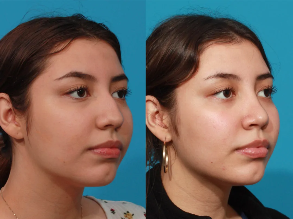 Пациентка пластического хирурга Гукаса Миракяна до и после ринопластики