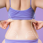 Криолиполиз или липосакция: что выбрать?