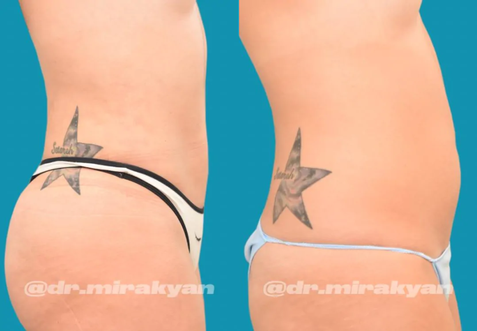 Пациентка доктора Гукаса Миракяна до и после липосакции