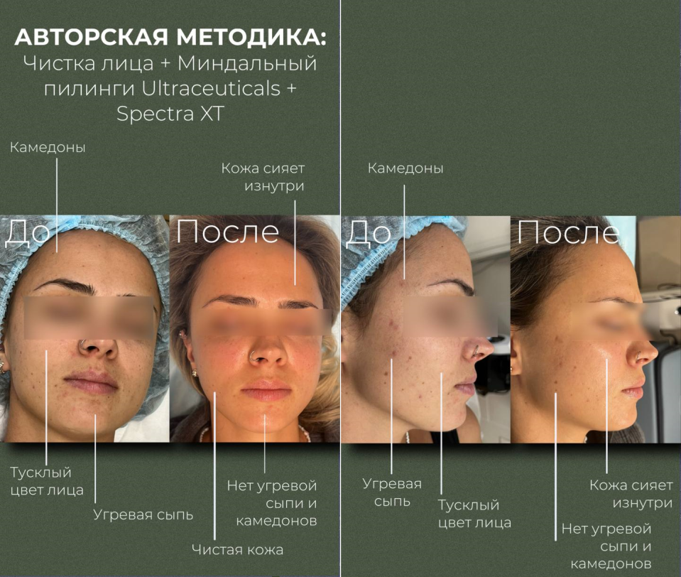 Пациентка клиники NBC. Фото до и после авторской методики чистки лица в комбинации с миндальным пилингом