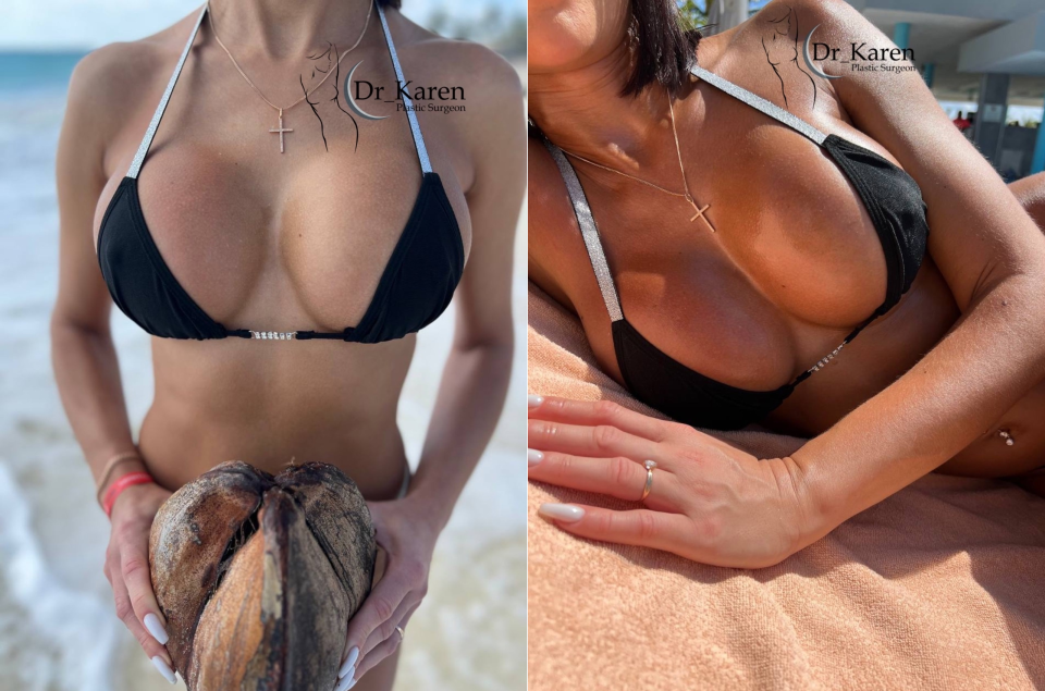 Пациентка доктора Карена после увеличения груди имплантами. Фотоотзыв