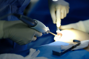 Неправильное рассечение кармана во время операции