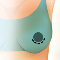 Липофилинг или импланты?