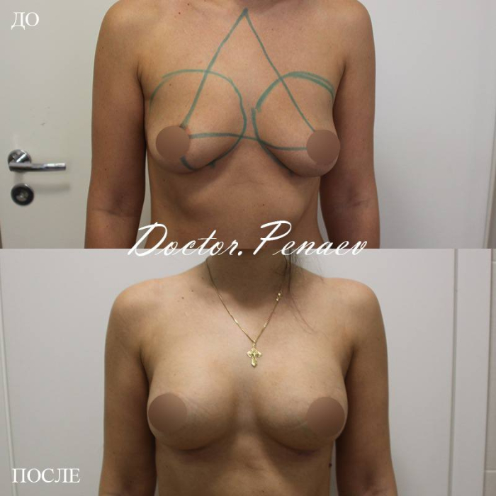 Пациентка доктора А.А. Пенаева, 32 года, недостаточно желаемый объем молочных желез. Выполнено протезирование молочных желез высокопрофильными имплантами SILIMED 295 ml. Результат через 6 месяцев после операции