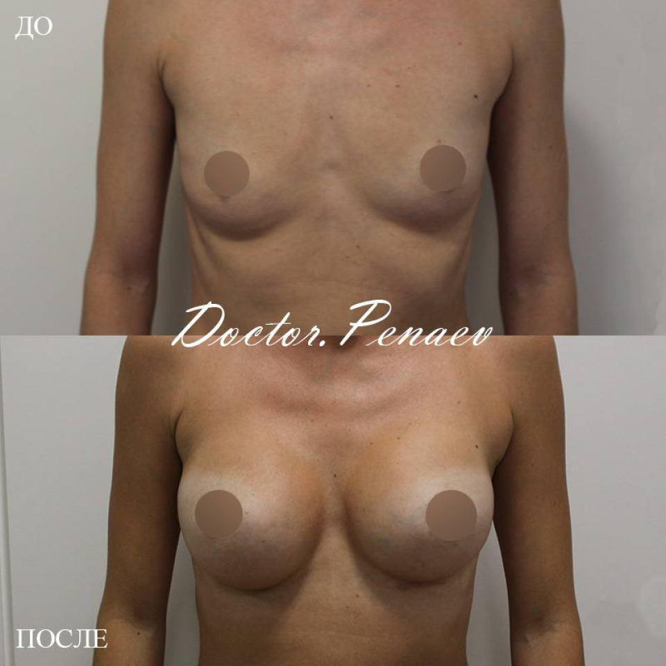 Пациентка доктора Арслана Пенаева. До и  после коррекции микромастии
