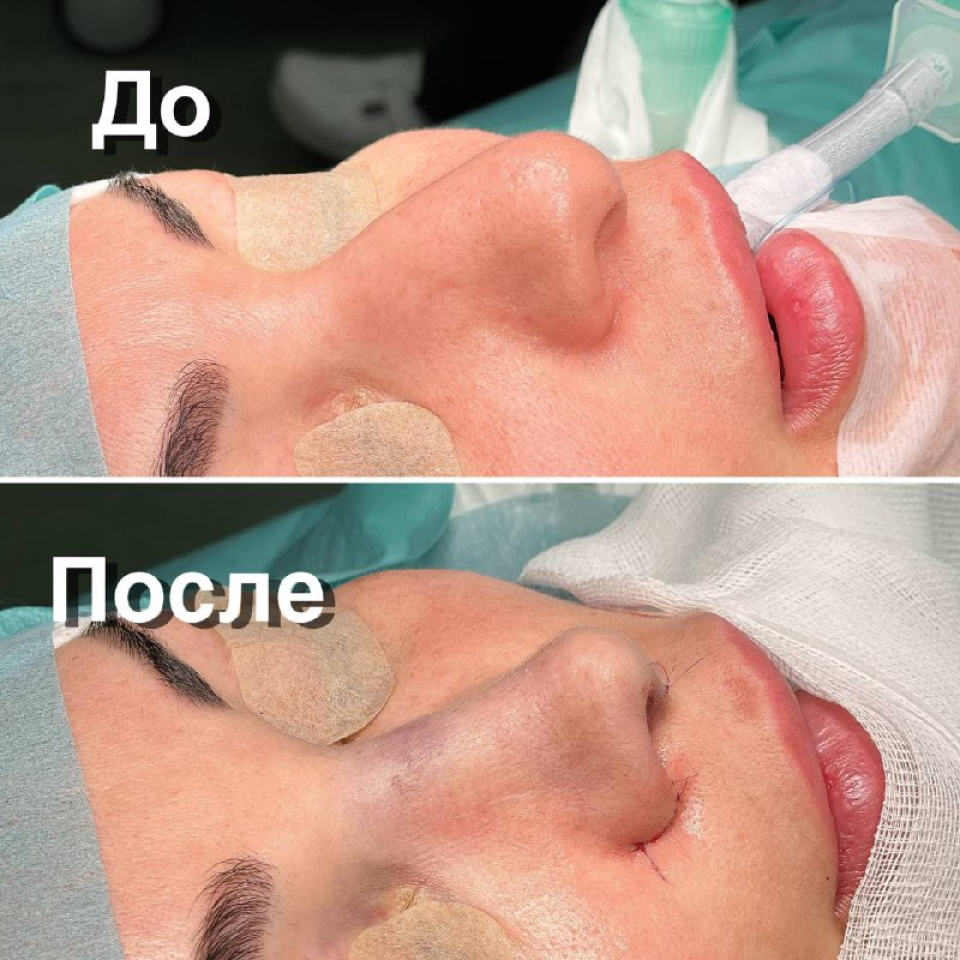 Пациентка пластического хирурга Валерия Стайсупова. Ринопластика носа с очень толстой кожей.