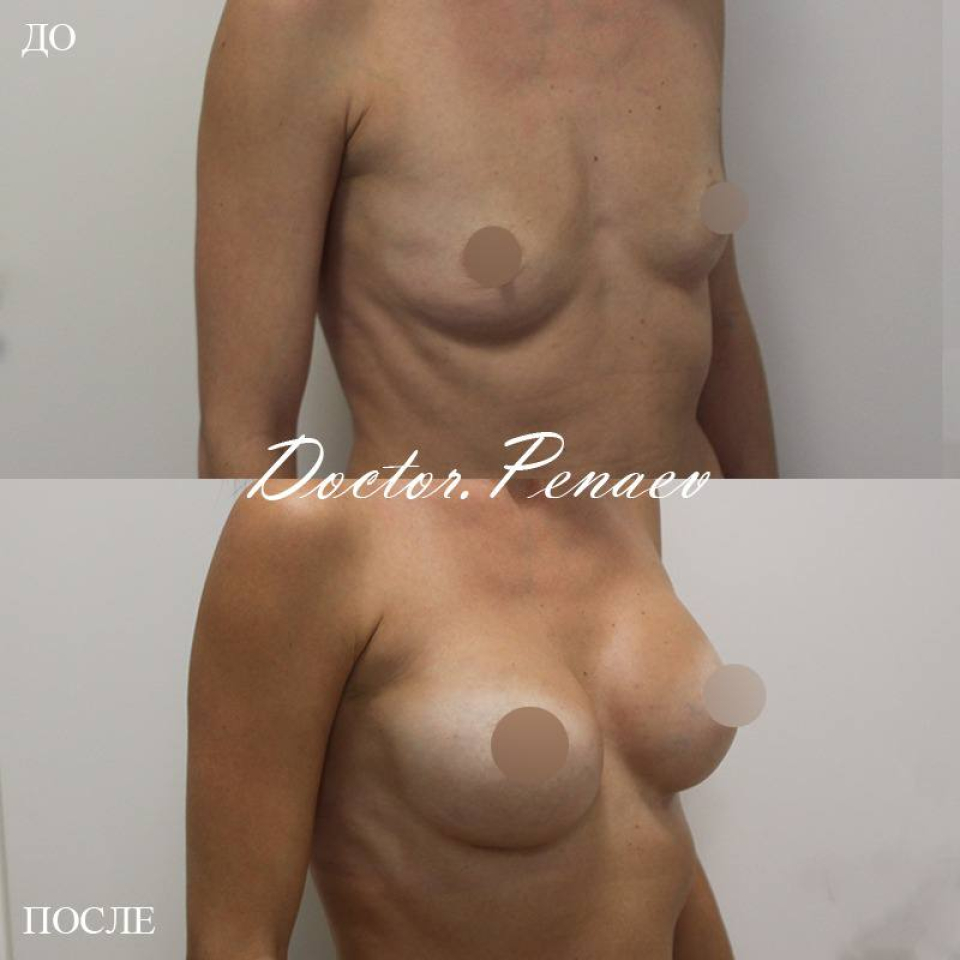 Пациентка доктора Арслана Пенаева. Фото до и  после коррекции микромастии