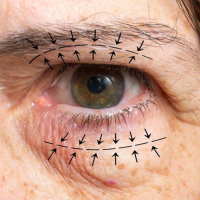 Микрохирургическая блефаропластика