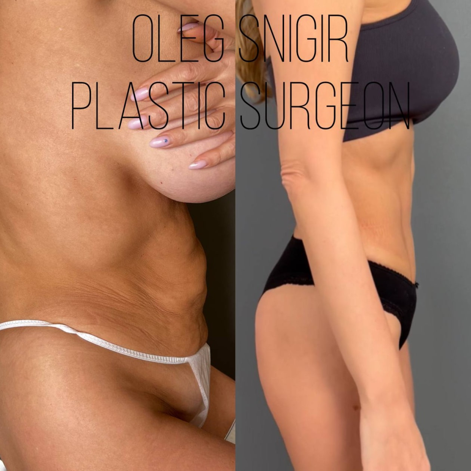 Липомоделирование тела у доктора Олега Снигиря