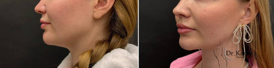 Липомоделирование подбородка. Пациентка Карена Пайтяна