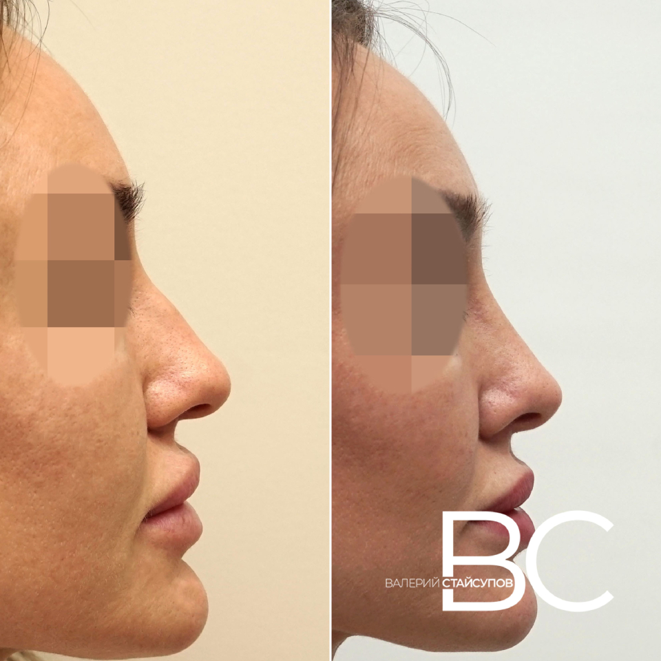 Ринопластика кончика носа Стайсупов