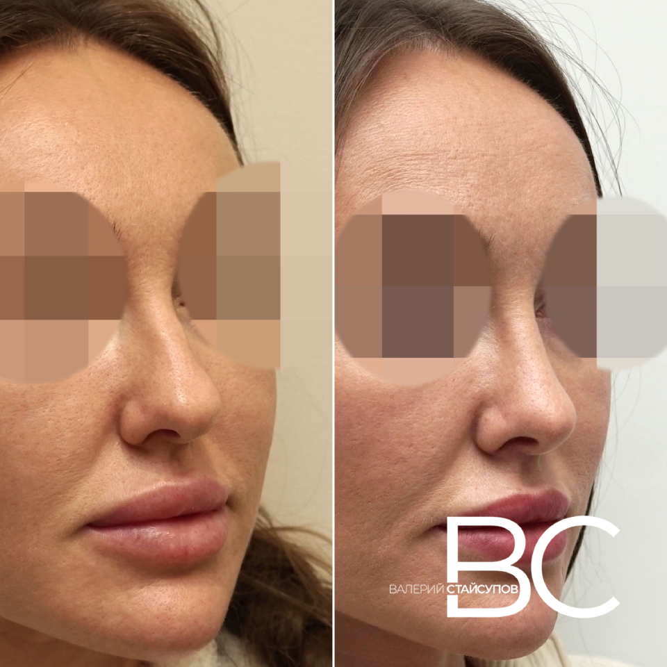 Закрытая ринопластика Стайсупов