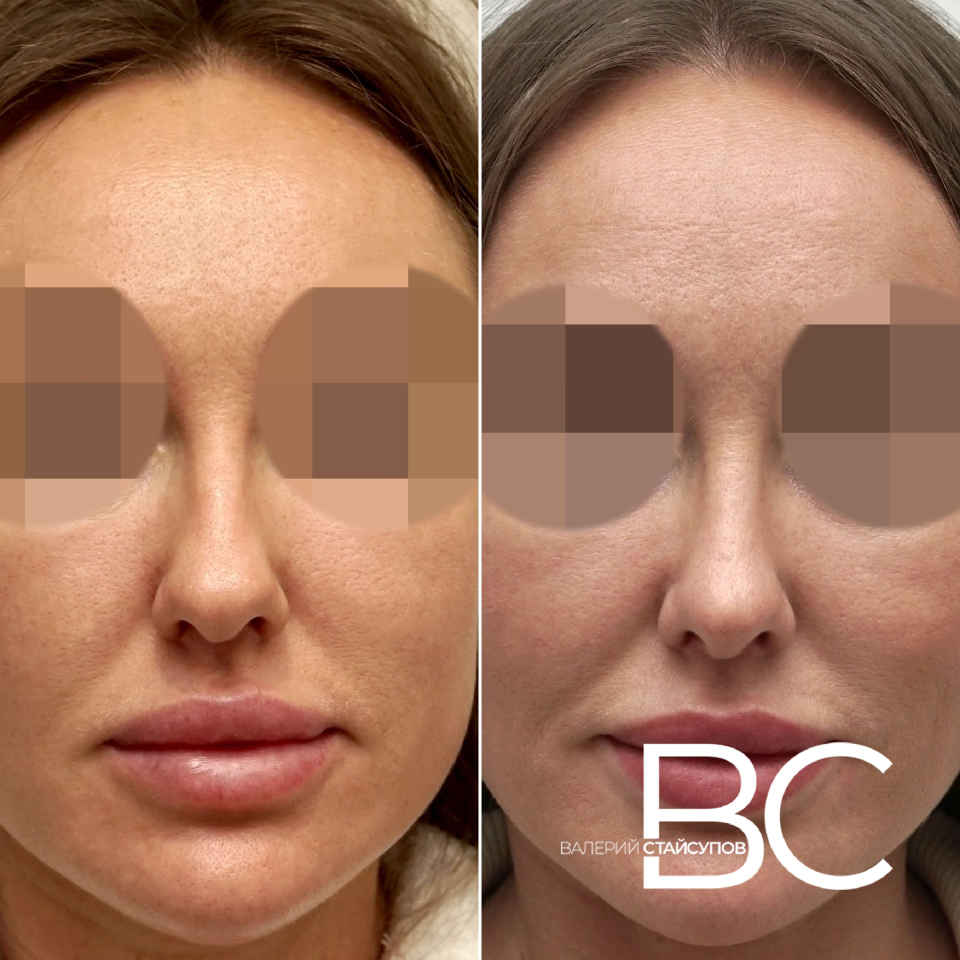 ринопластика кончика носа Стайсупов