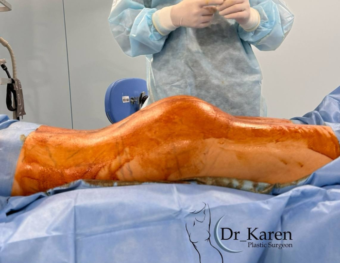 Идеальный результат липомоделирование тела с увеличением ягодиц