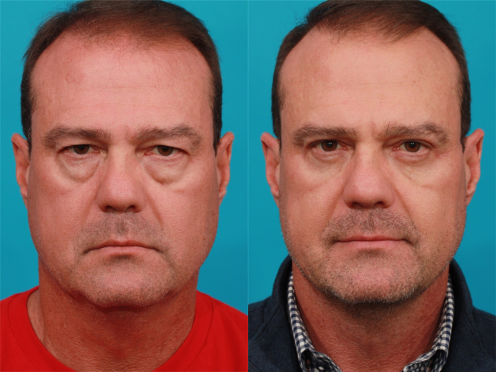 Пациент доктора Гукаса Миракяна до и после блефаропластики