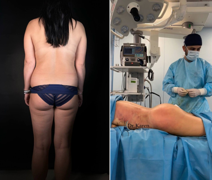 Липофилинг ягодиц