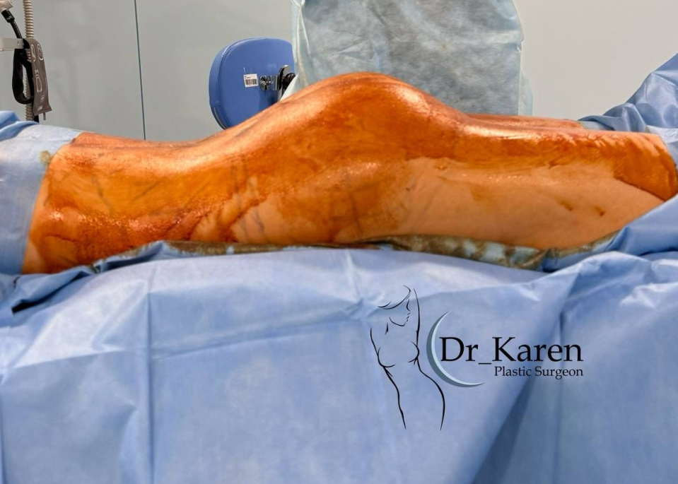 Пациентка доктора Карена Пайтяна сразу после липофилинга ягодиц