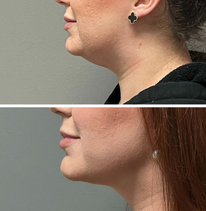 Лилит Чолоян. Липомоделирование подбородка