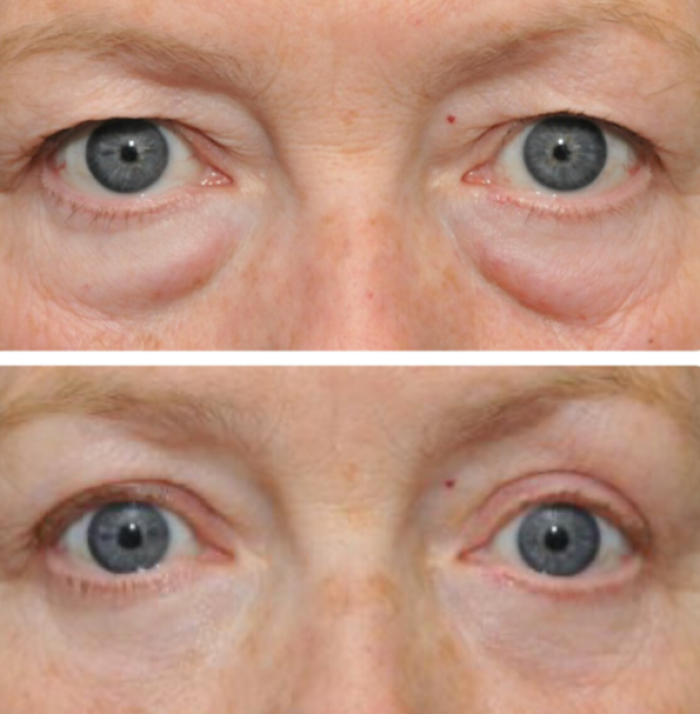 Удаление мешков под глазами, Лилит Чолоян