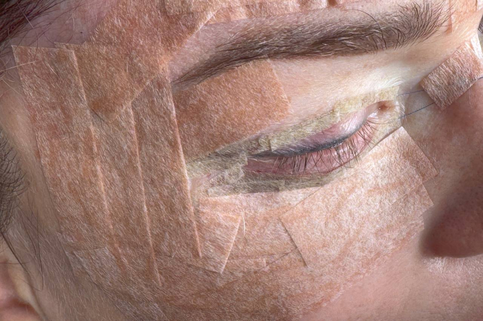 Тейпирование после пластических операций