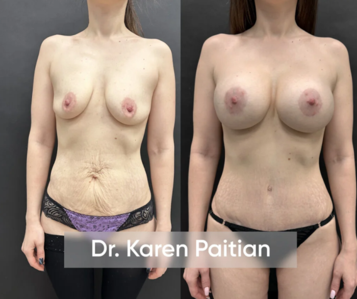 Пациентка доктора Карена Пайтяна до и после авторской коррекции «Постнатал»